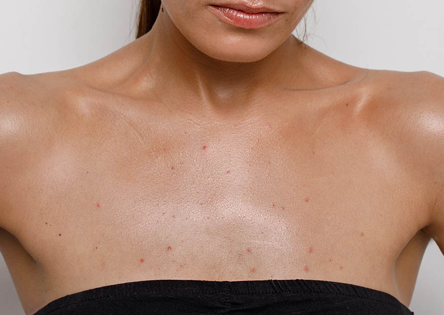 6 Pro Tips to Get Rid of Chest Acne