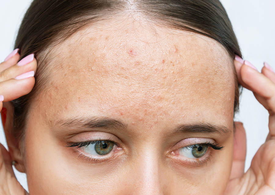10 Pro Tips To Get Rid Of Forehead Acne