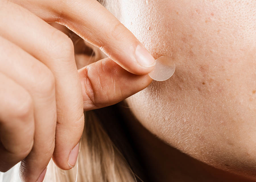 How Do Pimple Patches Work To Improve Acne?